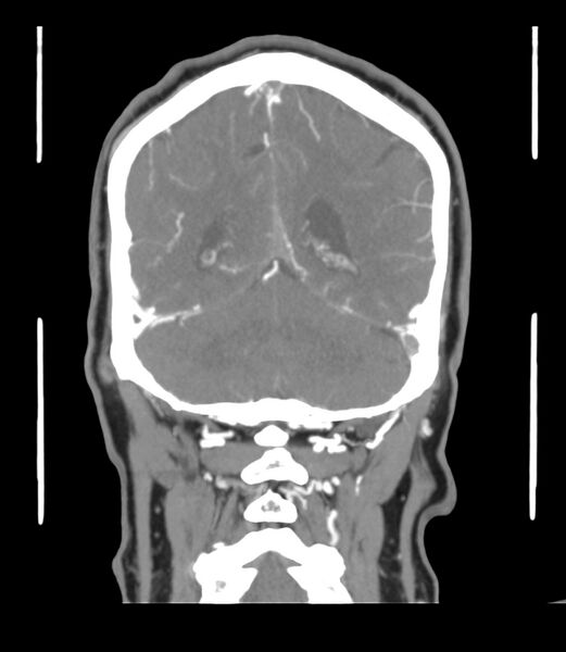 File:Cerebral dural venous sinus thrombosis (Radiopaedia 86514-102576 B 54).jpg