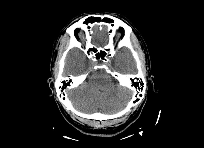 Cerebral edema (Radiopaedia 82519-96661 Axial non-contrast 41).jpg