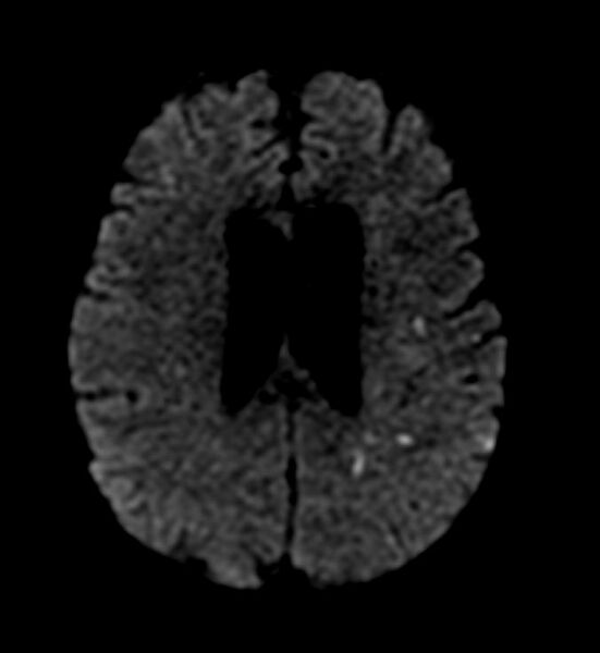 File:Cerebral embolic infarction (Radiopaedia 11288-11652 B 1).jpg