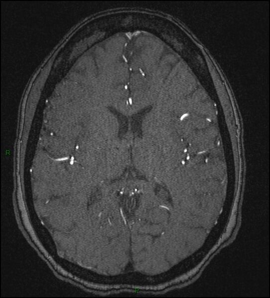 File:Cerebral fat embolism (Radiopaedia 35022-36525 Axial TOF 118).jpg