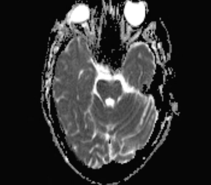 File:Cerebral venous thrombosis (Radiopaedia 71207-81504 Axial ADC 6).jpg