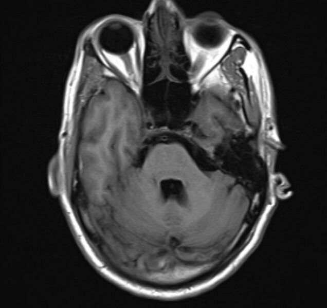 File:Cerebral venous thrombosis (Radiopaedia 71207-81504 Axial T1 8).jpg