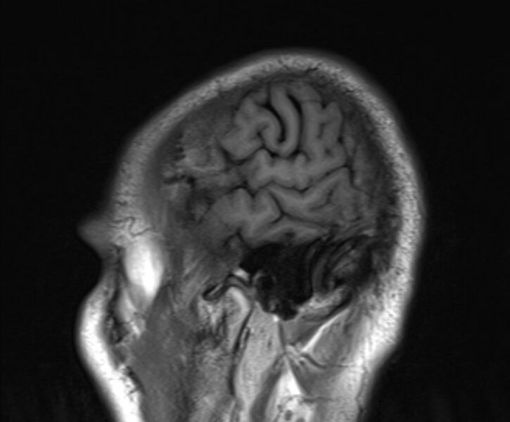 File:Cerebral venous thrombosis (Radiopaedia 71207-81504 Sagittal T1 3).jpg