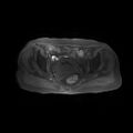 Cervical carcinoma (Radiopaedia 78847-91705 Axial T1 fat sat 9).jpg