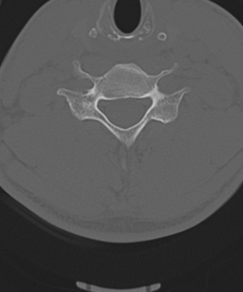 File:Cervical intercalary bone (Radiopaedia 35211-36748 Axial bone window 43).png