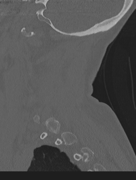 File:Cervical spondylolysis (Radiopaedia 49616-54811 Sagittal bone window 56).png
