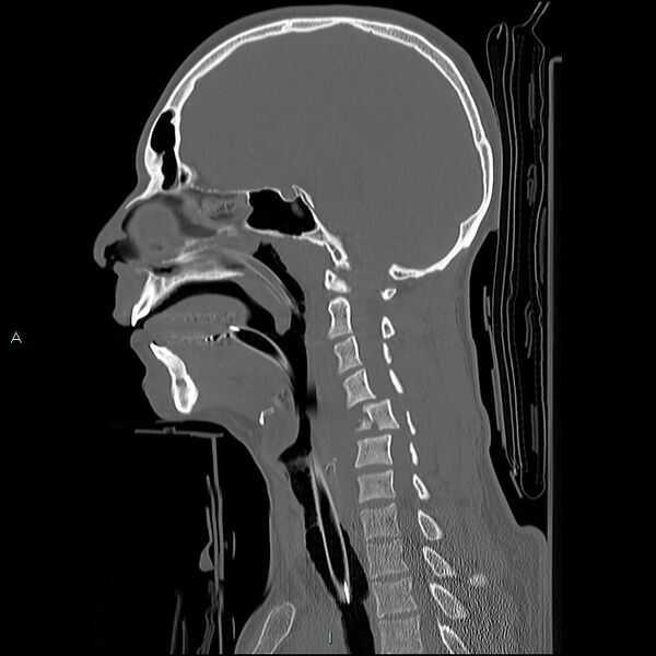File:Cervical vertebral burst fracture (Radiopaedia 37420-39258 Sagittal bone window 18).jpg