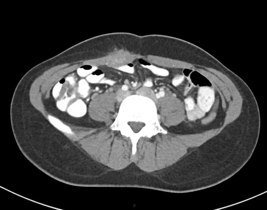Cesarean scar endometriosis (Radiopaedia 82925-97262 A 53).jpg