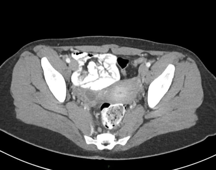 Cesarean scar endometriosis (Radiopaedia 82925-97262 A 74).jpg