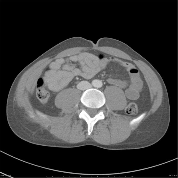 File:Chest and abdomen multi-trauma (Radiopaedia 26294-26426 bone window 54).jpg