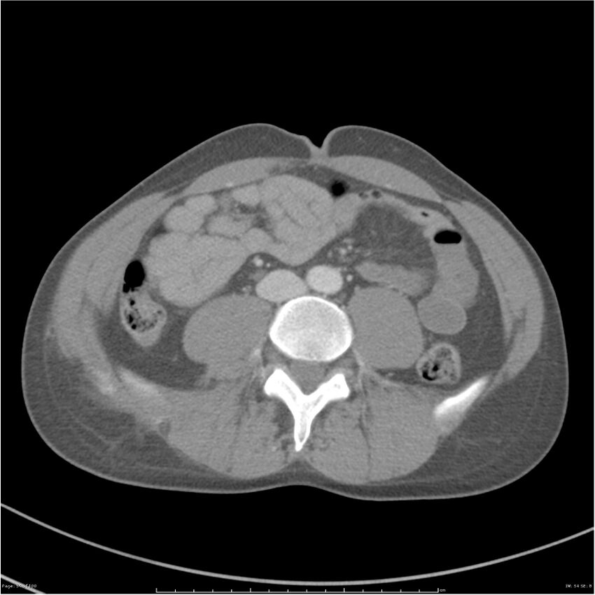 Chest and abdomen multi-trauma (Radiopaedia 26294-26426 bone window 54).jpg