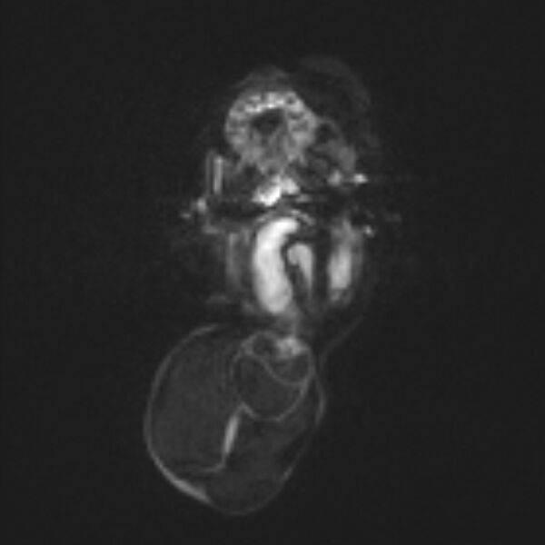 File:Chiari III malformation with occipital encephalocele (Radiopaedia 79446-92559 Axial DWI 28).jpg