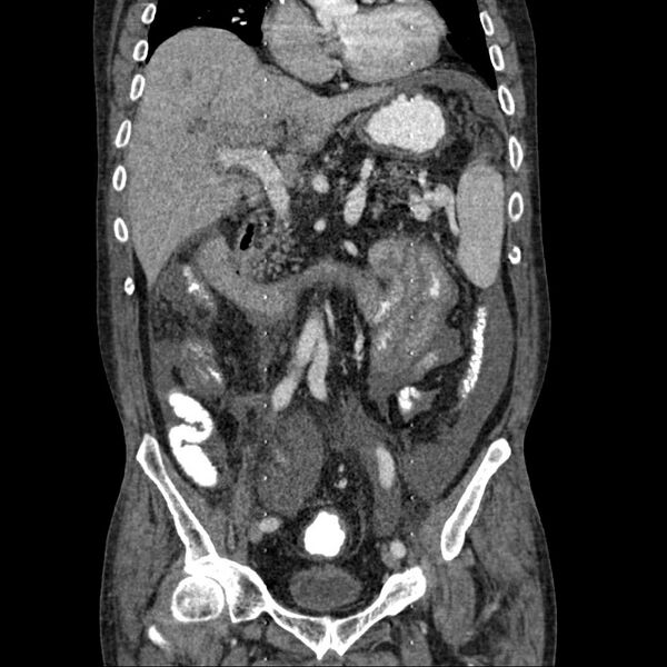 File:Cholangitis and abscess formation in a patient with cholangiocarcinoma (Radiopaedia 21194-21100 C 10).jpg