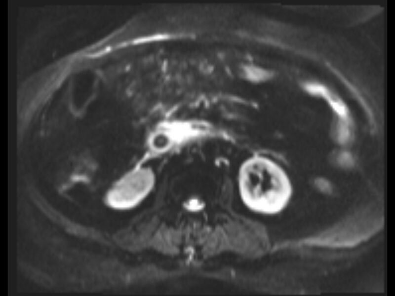 File:Choledocholithiasis causing intrahepatic biliary duct dilation (Radiopaedia 39908-42369 Axial T2 SPAIR 3).jpg