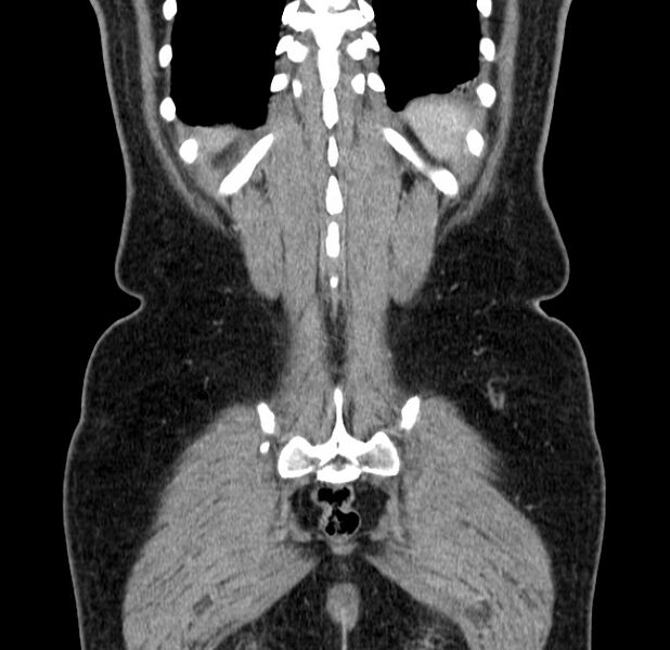 File:Choledocholithiasis on CT and MRI (Radiopaedia 24825-25087 C 47).jpg
