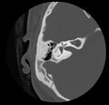 Cholesteatoma (Radiopaedia 20296-20217 bone window 28).jpg