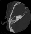 Cholesteatoma (Radiopaedia 5467-7197 Axial bone window 10).jpg