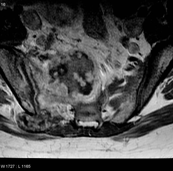 File:Chondrosarcoma - sacrum (Radiopaedia 6173-7627 Axial T1 C+ 3).jpg