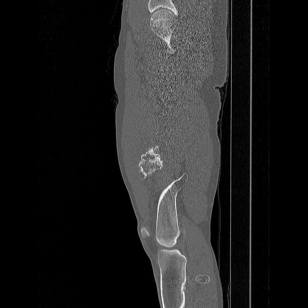 File:Chondrosarcoma arising from exostosis (Radiopaedia 59996-67507 Sagittal bone window 10).jpg