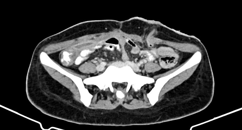 File:Choriocarcinoma liver metastases (Radiopaedia 74768-85766 A 146).jpg