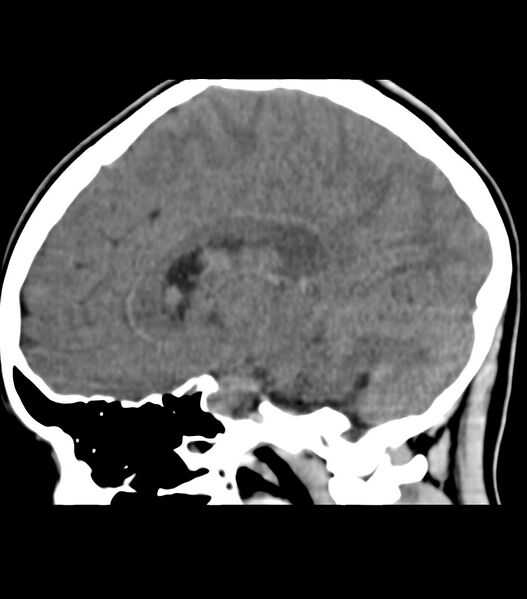 File:Choroid plexus carcinoma (Radiopaedia 91013-108552 B 32).jpg