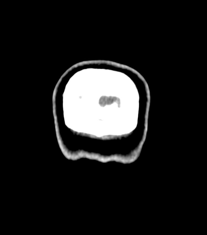 Choroid plexus carcinoma (Radiopaedia 91013-108552 Coronal non-contrast 86).jpg