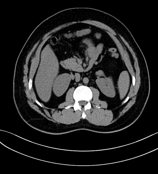 File:Chromophobe renal cell carcinoma (Radiopaedia 84286-99573 Axial non-contrast 19).jpg