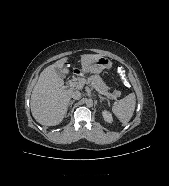File:Chromophobe renal cell carcinoma (Radiopaedia 84337-99644 Axial C+ delayed 41).jpg