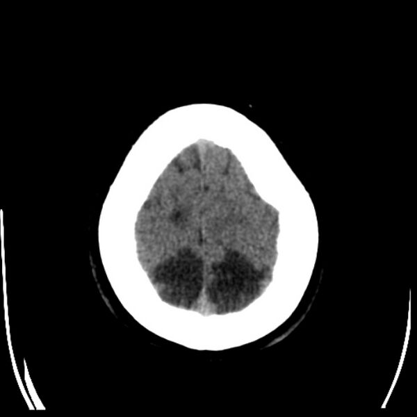 File:Chronic bilateral occipital lobe infarcts (Radiopaedia 31276-31996 Axial non-contrast 38).jpg