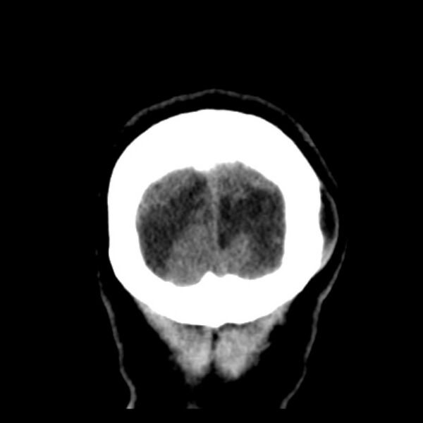 File:Chronic bilateral occipital lobe infarcts (Radiopaedia 31276-31996 Coronal non-contrast 45).jpg