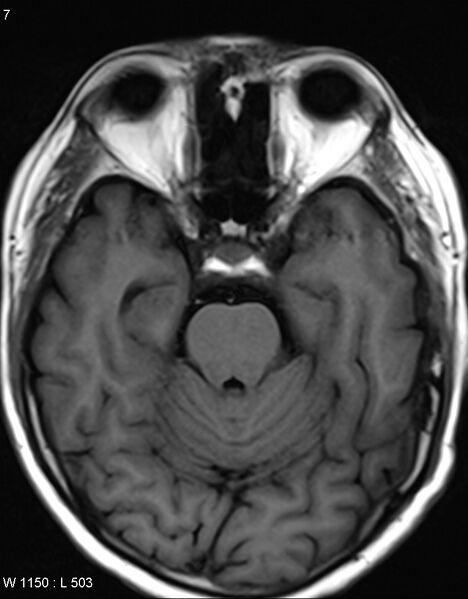 File:Chronic lymphocytic inflammation with pontine perivascular enhancement responsive to steroids (CLIPPERS) (Radiopaedia 37520-39374 Axial T1 6).jpg