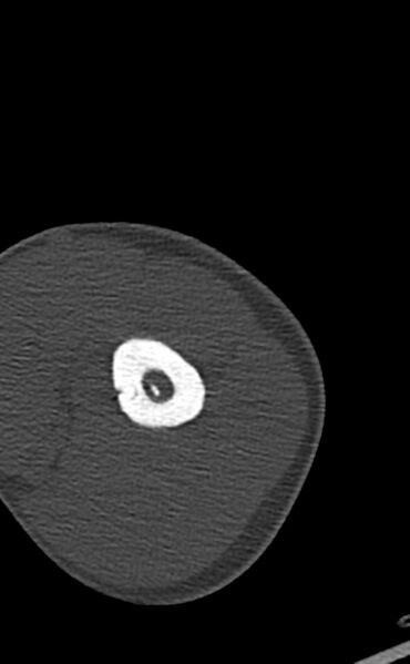 File:Chronic osteomyelitis of the distal humerus (Radiopaedia 78351-90971 Axial bone window 34).jpg