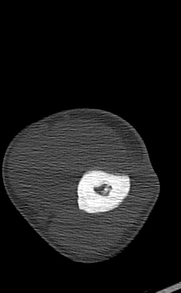 File:Chronic osteomyelitis of the distal humerus (Radiopaedia 78351-90971 Axial bone window 64).jpg