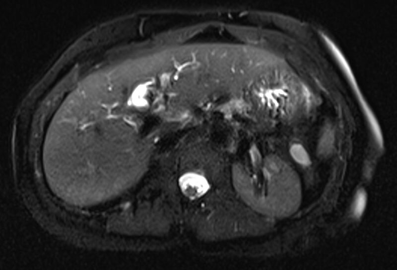 File:Chronic pancreatitis - pancreatic duct calculi (Radiopaedia 71818-82250 Axial T2 fat sat 21).jpg