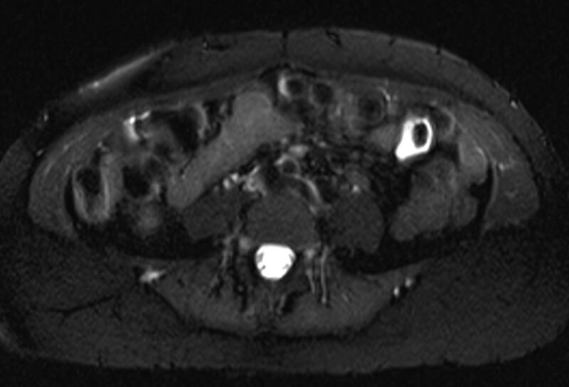 File:Chronic pancreatitis - pancreatic duct calculi (Radiopaedia 71818-82250 Axial T2 fat sat 50).jpg