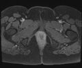 Class II Mullerian duct anomaly- unicornuate uterus with rudimentary horn and non-communicating cavity (Radiopaedia 39441-41755 Axial T1 fat sat 140).jpg
