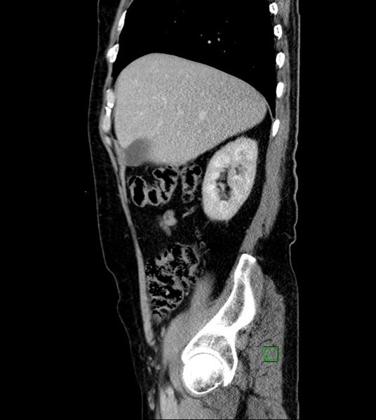 File:Clear cell renal cell carcinoma (Radiopaedia 85006-100539 G 47).jpg