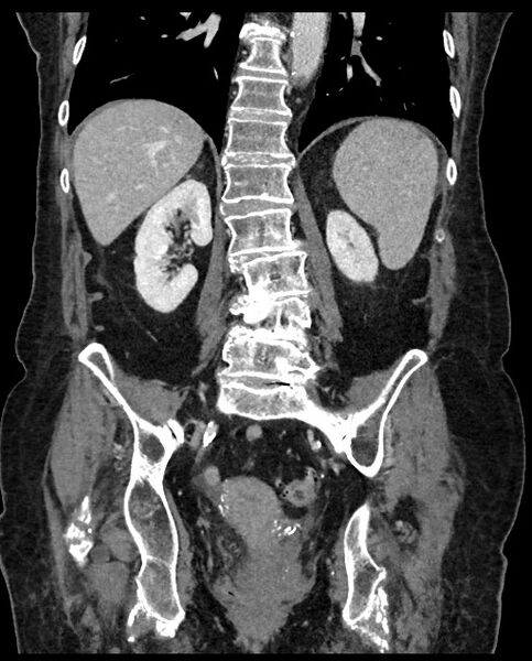 File:Closed loop small bowel obstruction - adhesions (Radiopaedia 59269-66611 B 84).jpg