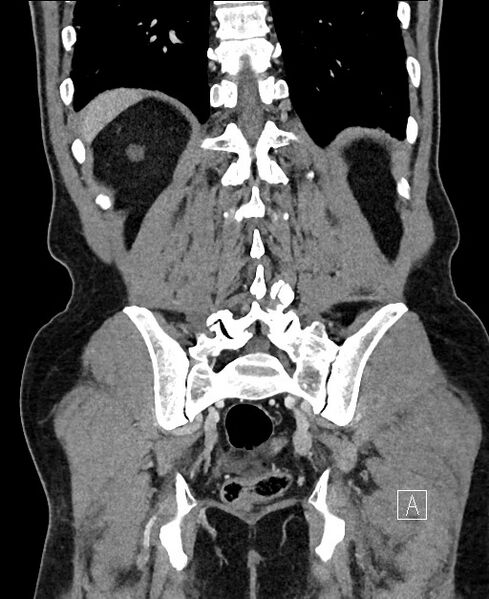 File:Closed loop small bowel obstruction - internal hernia (Radiopaedia 57806-64778 A 94).jpg
