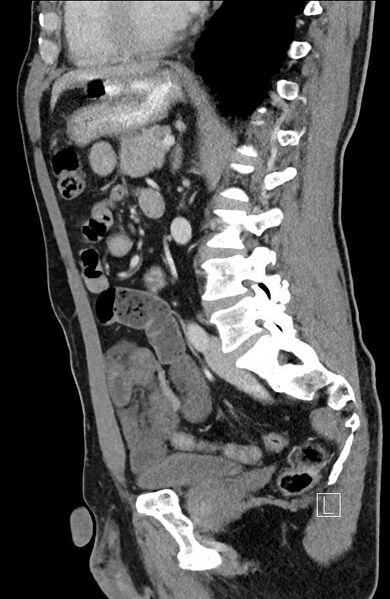 File:Closed loop small bowel obstruction - internal hernia (Radiopaedia 57806-64778 C 49).jpg