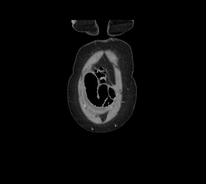 File:Cocoon abdomen with possible tubo-ovarian abscess (Radiopaedia 46235-50636 B 2).jpg