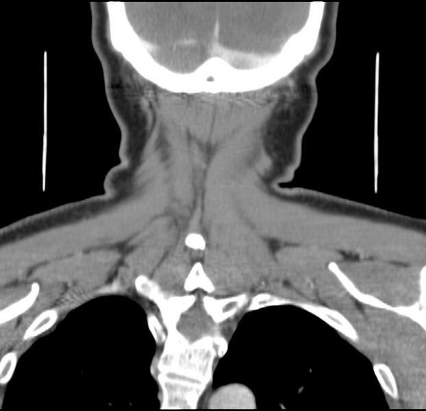File:Colloid cyst of thyroid (Radiopaedia 22897-22923 Coronal C+ delayed 54).jpg