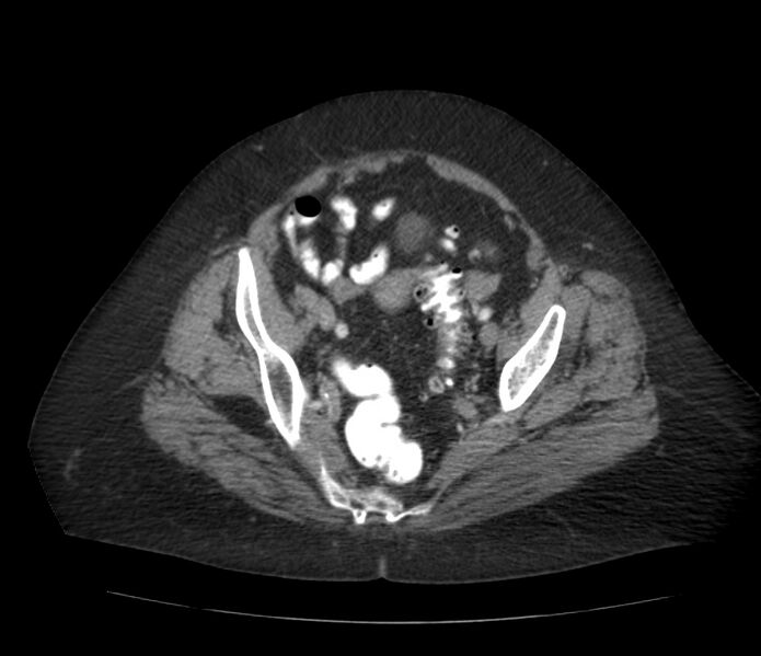 File:Colonic diverticulosis (Radiopaedia 22934-22957 A 61).jpg