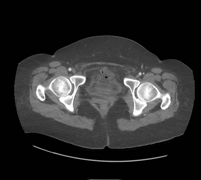 File:Colonic pseudo-obstruction (Radiopaedia 79752-92980 A 183).png