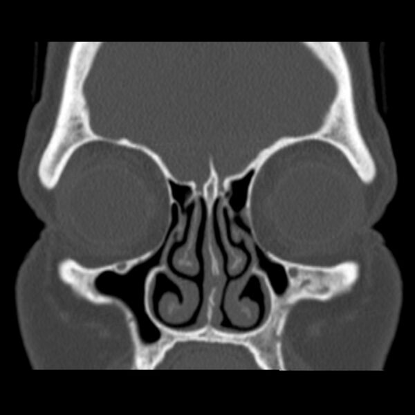 File:Nasolabial cyst (Radiopaedia 33987-35205 Coronal bone window 30).jpg