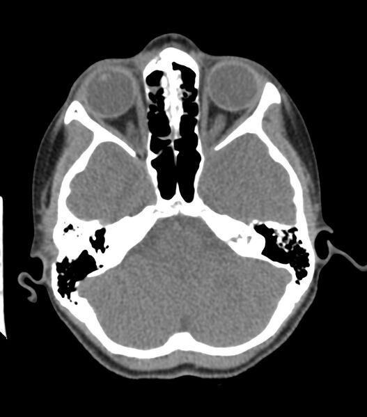 File:Nasoorbitoethmoid fracture (Radiopaedia 90044-107205 Axial non-contrast 161).jpg
