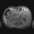 Nephroblastomatosis (Radiopaedia 39984-42477 Axial 1).png