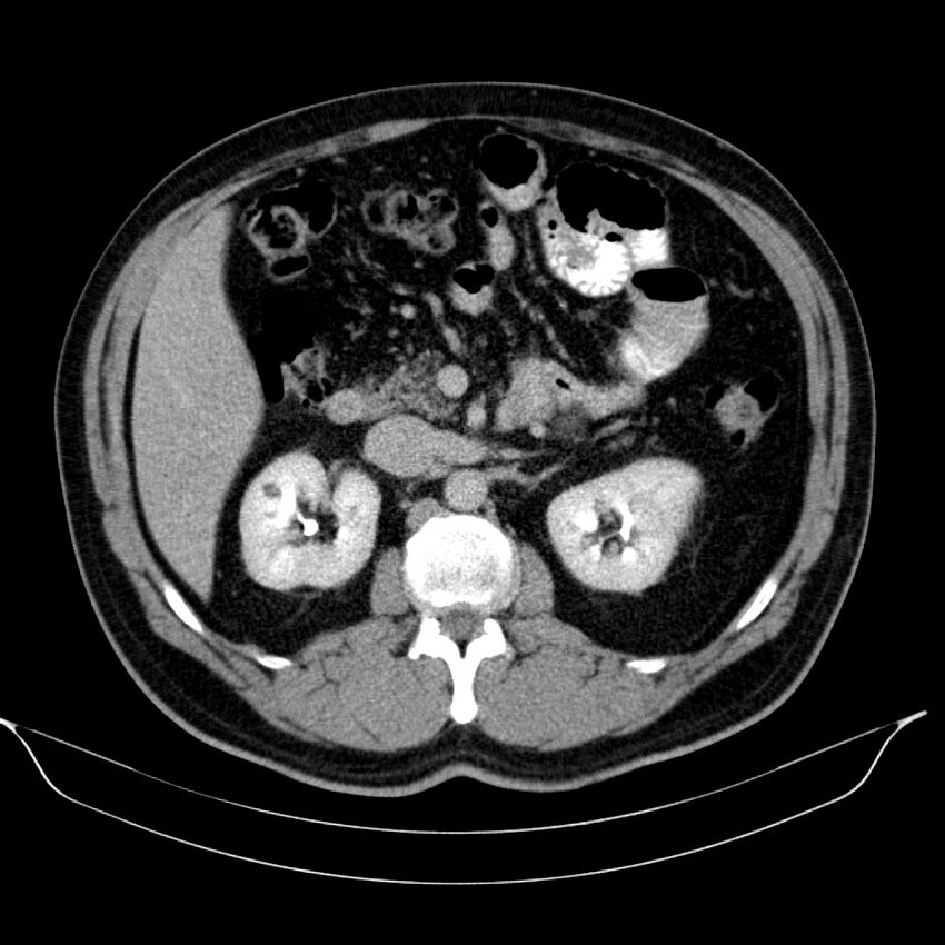 Neuroendocrine tumor of head of pancreas (Radiopaedia 57538-64502 D 33).jpg