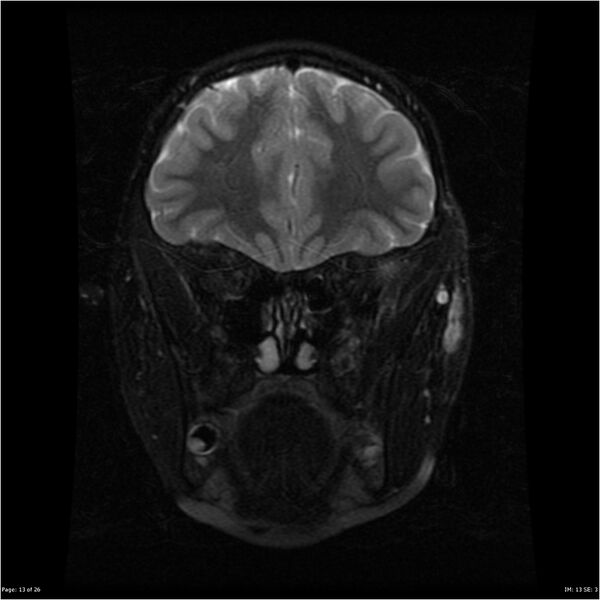 File:Neurofibromatosis type 1 (Radiopaedia 22541-22564 C 13).jpg