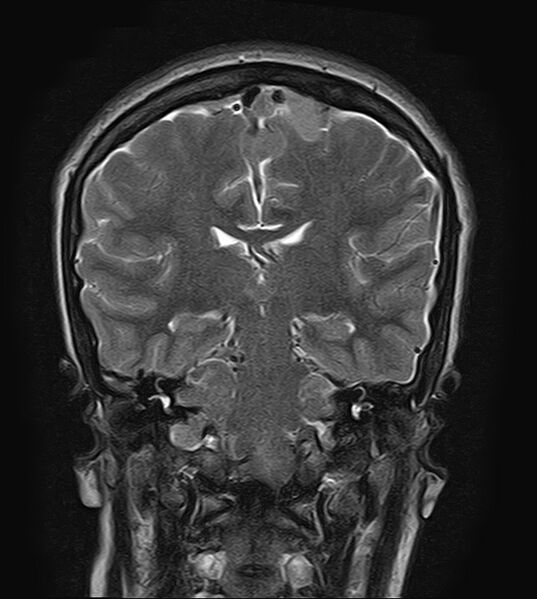 File:Neurofibromatosis type 2 (Radiopaedia 66211-75401 Coronal T2 14).jpg